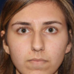Rhinoplasty - Front Face View - Before Pic - Hump removal - slight tip elevation and refinement - Chin augmentation - Nose Job in Beverly Hills