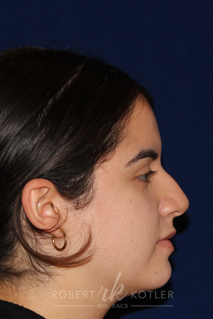 Rhinoplasty - Right Profile - Before Pic - Hump Removal - Nose tip refinement - Tip elevation - Nose Job in Beverly Hills