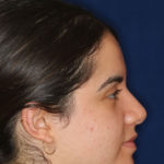 Rhinoplasty -Right Profile - After Pic - Hump Removal - Nose tip refinement - Tip elevation - Best Nose Job Surgeon
