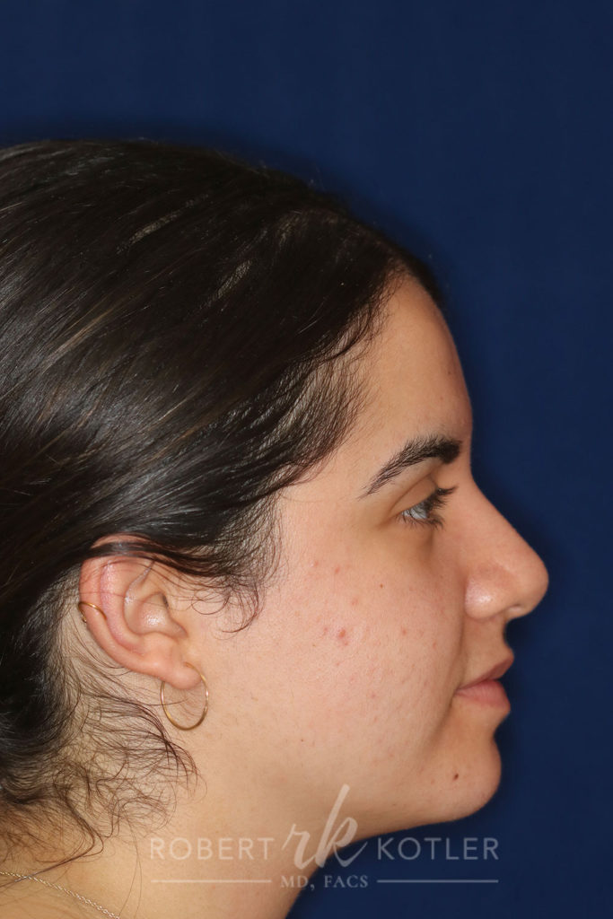 Rhinoplasty -Right Profile - After Pic - Hump Removal - Nose tip refinement - Tip elevation - Best Nose Job Surgeon