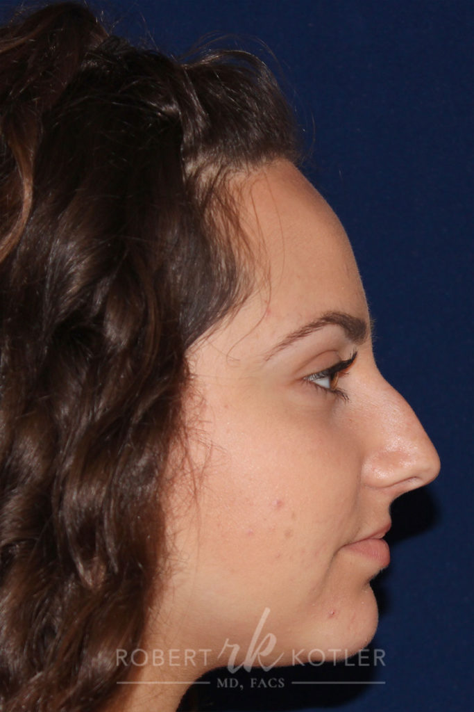Closed Rhinoplasty - Right Profile - Before Pic - Crooked nose correction - Hump removal - correction of blocked breathing - Beverly Hills Rhinoplasty Superspecialist