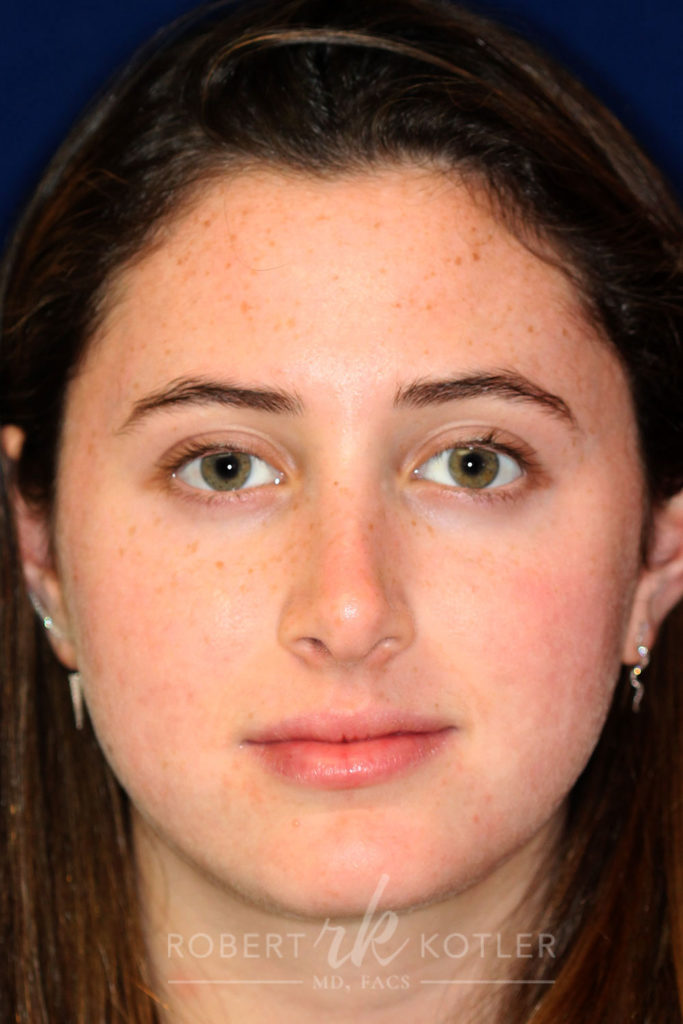 Rhinoplasty - Front Face View - After Pic - Hump removal - Tip correction and refinement - Nose Job in Beverly Hills