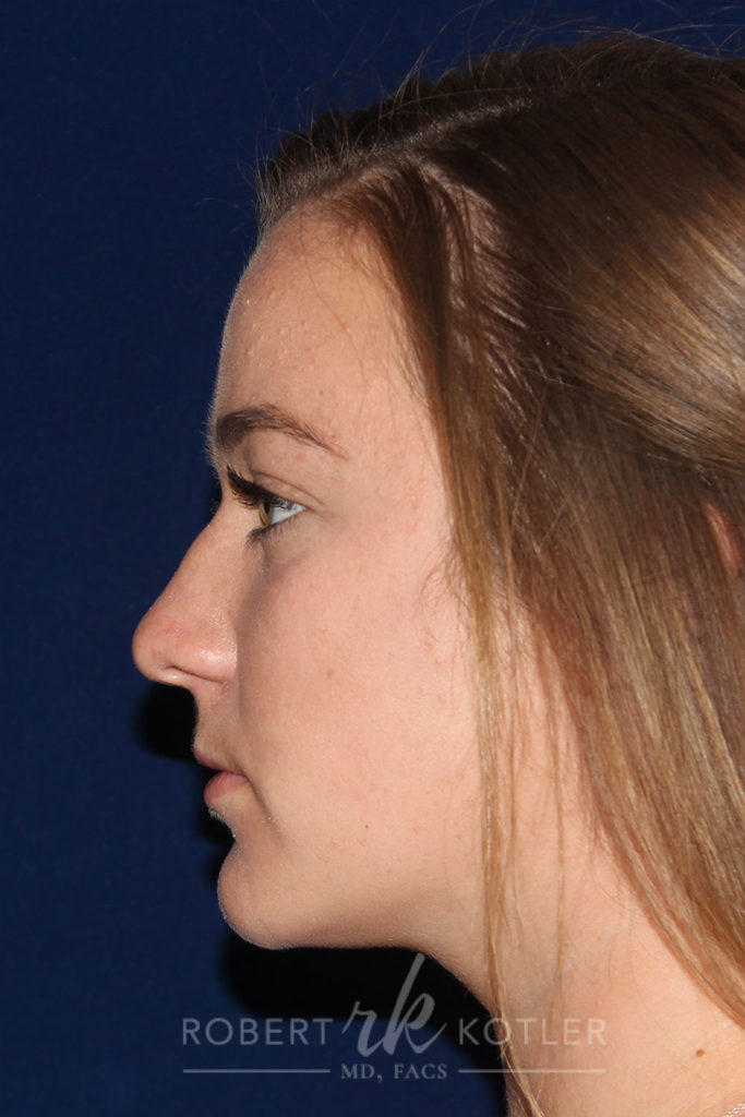 Closed Rhinoplasty - Left Profile - Before Pic - Hump removal - tip refinement - narrowing of bone - Best Nose Job Surgeon