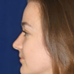 Closed Rhinoplasty - Left Profile - After Pic - Hump removal - tip refinement - narrowing of bone and cartilage - Top Rhinoplasty Surgeon