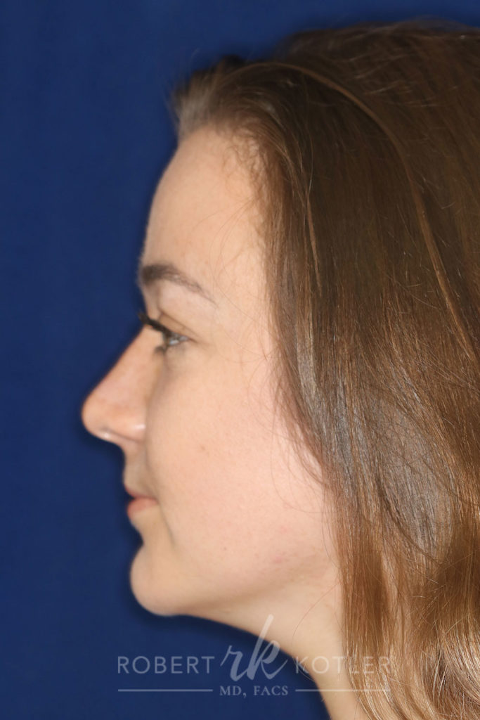 Closed Rhinoplasty - Left Profile - After Pic - Hump removal - tip refinement - narrowing of bone and cartilage - Top Rhinoplasty Surgeon