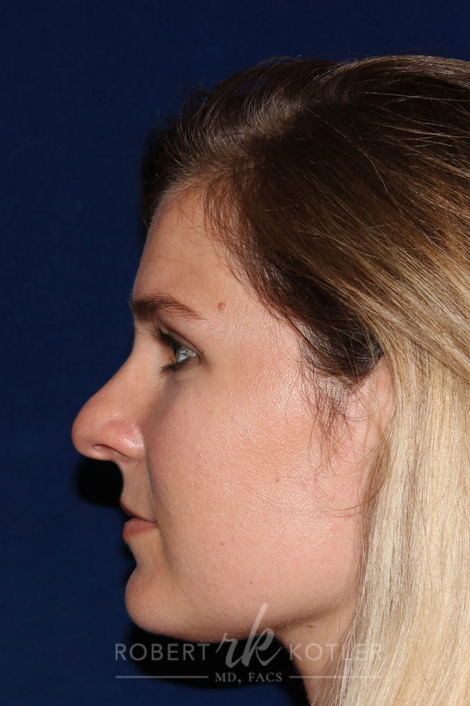 Rhinoplasty - Left Profile - Before pic - Hump removal - Bulbous nose tip refinement and recession - Rhinoplasty Surgeon in Beverly Hills