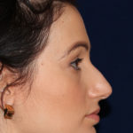 Rhinoplasty - Right Profile - Before Pic - Hump removal, tip refinement - Crooked nose correction - Top Rhinoplasty Surgeon