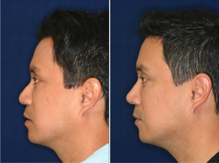 Permanent Non-surgical Rhinoplasty