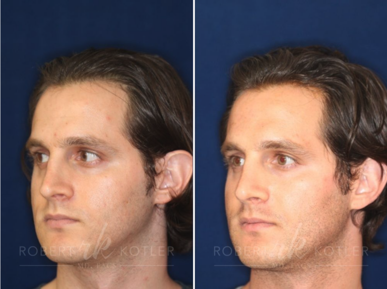 Non-Surgical Nose Job