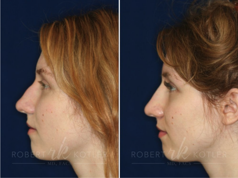 Non-Surgical Rhinoplasty