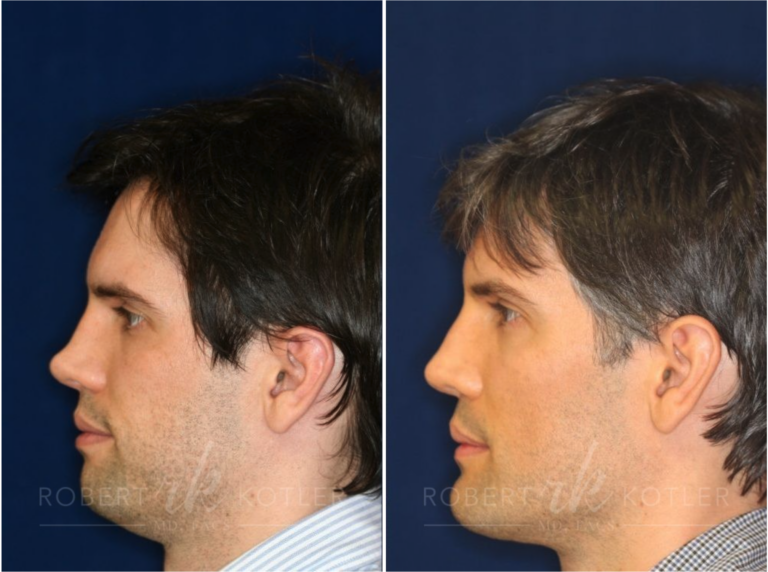 Permanent Non-Surgical Rhinoplasty