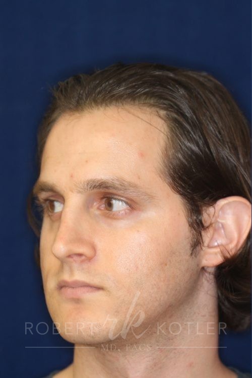 Permanent Non-surgical Rhinoplasty - Left Angled Profile - Before Pic - Correction of pinched tip - Nose tip refinement - Top Rhinoplasty Surgeon