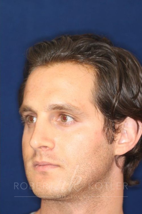 Permanent Non-surgical Rhinoplasty - Left Angled Profile - After Pic - Correction of pinched tip - Nose tip refinement - Beverly Hills Rhinoplasty Superspecialist