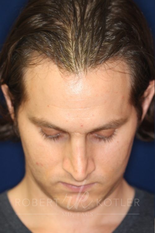 Permanent Non-surgical Rhinoplasty - Downward facing front view - Before Pic - Correction of pinched tip - Nose tip refinement - Best Rhinoplasty Beverly Hills