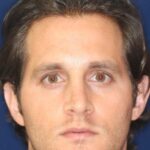 Permanent Non-surgical Rhinoplasty -Front face view - After Pic - Correction of pinched tip - Nose tip refinement - Beverly Hills Rhinoplasty Superspecialist