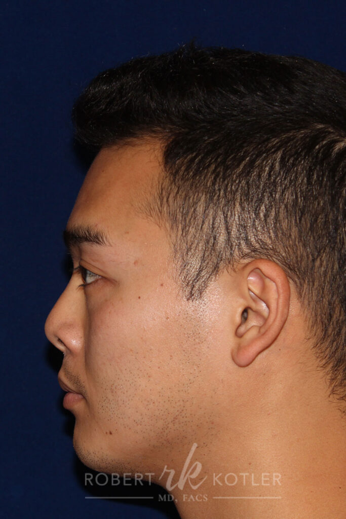 Non-Surgical Rhinoplasty - Left Profile - Before Pic - Retracted columella lowered - Small flat and receding tip corrected - Elevation of bridge - Best Rhinoplasty Beverly Hills