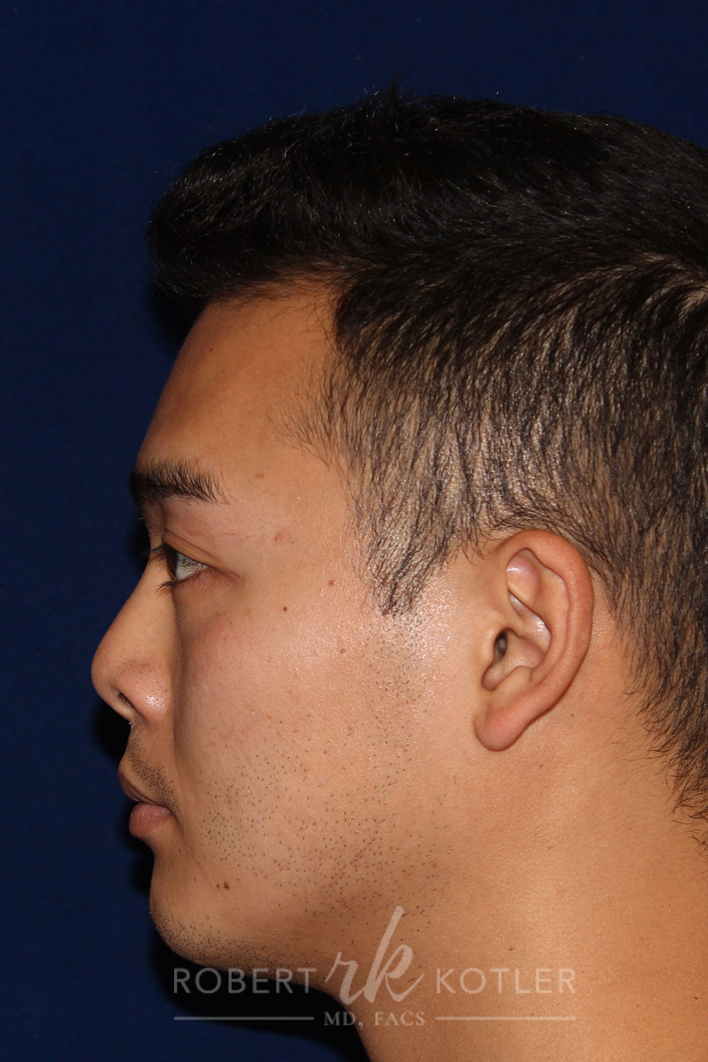 Non-Surgical Rhinoplasty - Left Profile - Before Pic - Retracted columella lowered - Small flat and receding tip corrected - Elevation of bridge - Best Rhinoplasty Beverly Hills