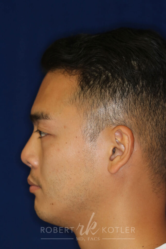 Non-Surgical Rhinoplasty - Left Profile - After Pic - Retracted columella lowered - Small flat and receding tip corrected - Elevation of bridge - Rhinoplasty Surgeon in Beverly Hills