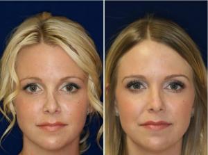 Permanent Micro-Droplet Silicone Injections for Botched Nose Jobs Still  Safe Says Rhinoplasty Specialist, Robert Kotler - Rhinoplasty & Nose  Surgery Beverly Hills | Dr. Robert Kotler