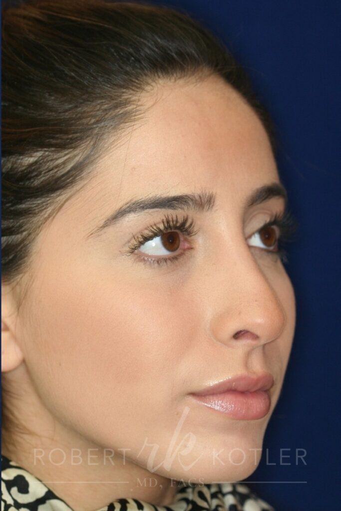 Conservative closed Rhinoplasty - Right Profile - After Pic - Hump removal - Nose tip refinement - Beverly Hills Rhinoplasty Superspecialist