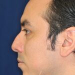 Rhinoplasty - Left Profile - Before Pic - Correction of nasal fracture - Hump removal - Tip refinement - Crooked nose straightened - Beverly Hills Rhinoplasty Superspecialist