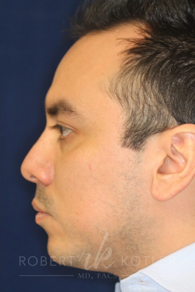 Rhinoplasty - Left Profile - After Pic - Correction of nasal fracture - Hump removal - Tip refinement - Crooked nose straightened - Best Rhinoplasty Beverly Hills