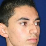 Closed Rhinoplasty - Right Profile - Before Pic - Hump removal - Elevation of nose from the lip - Tip refinement - Best Rhinoplasty Beverly Hills