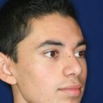 Closed Rhinoplasty - Right Profile -After Pic - Hump removal - Elevation of nose from the lip - Tip refinement - Rhinoplasty Surgeon in Beverly Hills