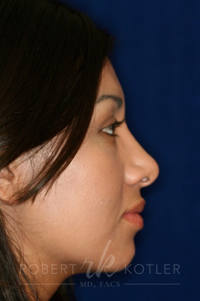 Closed Rhinoplasty - Right Profile - After Pic - Hump removal - Tip refinement - Top Rhinoplasty Surgeon