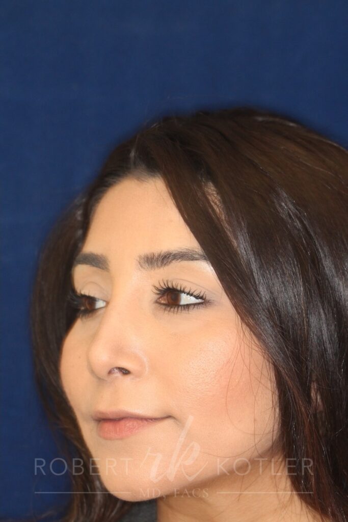 Closed Rhinoplasty - Left Angle Profile - After Pic - Hump removal - Tip refinement - Nose recessed closer to the face - Best Rhinoplasty Beverly Hills