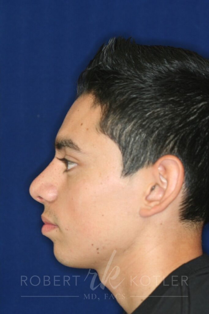 Closed Rhinoplasty - Left Profile - After Pic - Hump removal - Elevation of nose from the lip - Tip refinement - Top Rhinoplasty Surgeon
