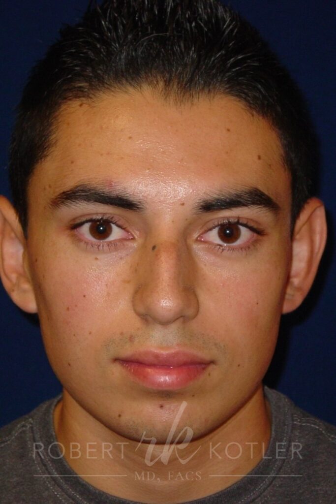Closed Rhinoplasty - Front Face View - After Pic - Hump removal - Elevation of nose from the lip - Tip refinement - Best Nose Job Surgeon