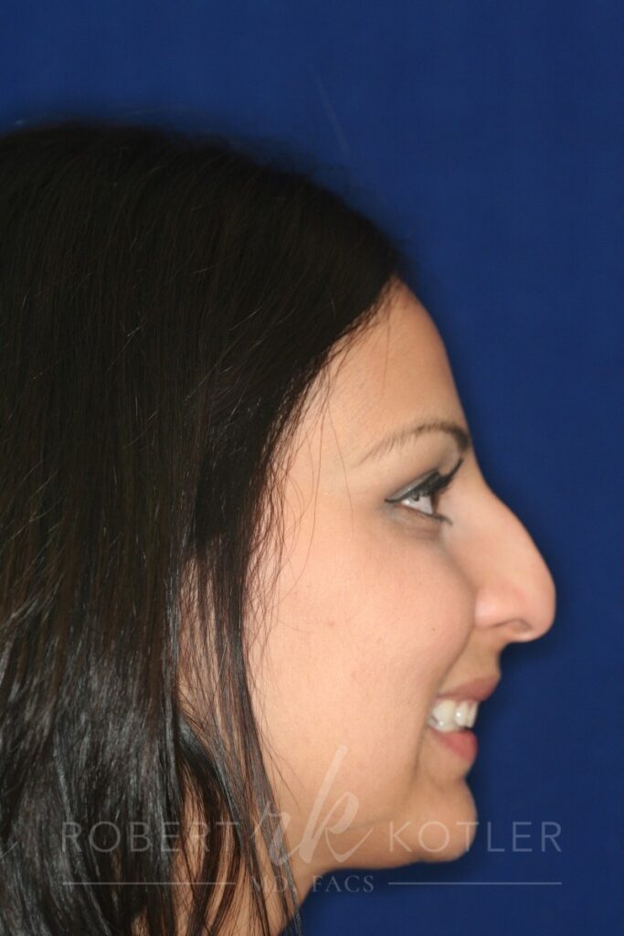 Closed Rhinoplasty - Right Profile - Smile - Before Pic - Hump removal - Lowered profile - Tip enhancement - Nose elevated from lip - Top Rhinoplasty Surgeon