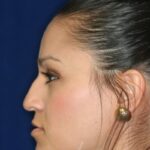 Closed Rhinoplasty - Left Profile - Before Pic - Hump removal - Tip refinement - Overall narrowing - Hanging tip elevated - Beverly Hills Rhinoplasty Superspecialist