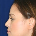 Closed Rhinoplasty - Left Profile - After Pic - Hump removal - Tip refinement - Overall narrowing - Hanging tip elevated - Best Rhinoplasty Beverly Hills