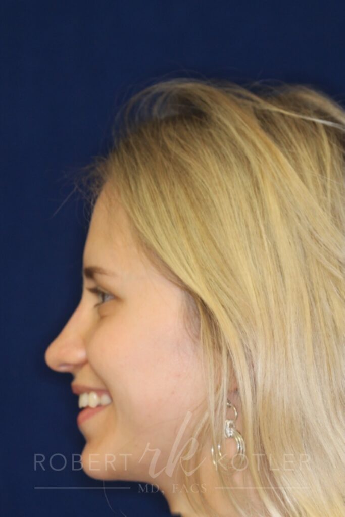 Closed Rhinoplasty - Left Profile - Before Pic - Hump removal - Nose tip refinement - Nose elevated from lip - Beverly Hills Rhinoplasty Superspecialist