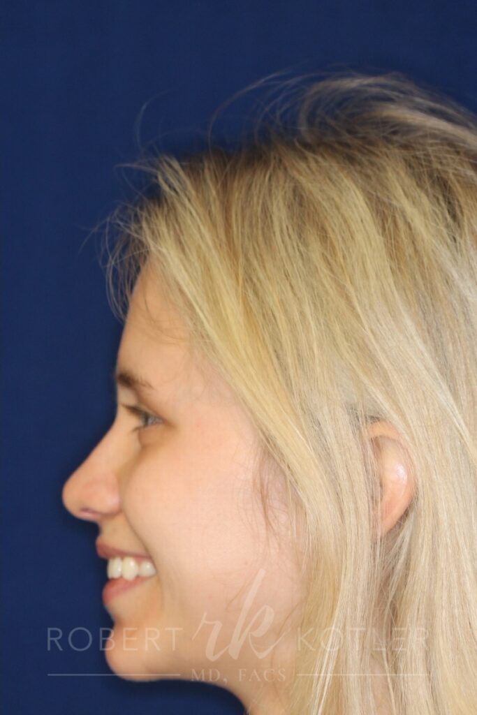 Closed Rhinoplasty - Left Profile - After Pic - Hump removal - Nose tip refinement - Nose elevated from lip - Best Rhinoplasty Beverly Hills
