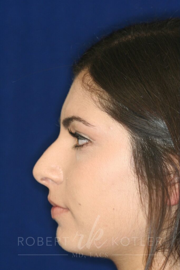 Closed Rhinoplasty - Left Profile - Before Pic - Hump removal - Tip refinement - Sculpture of nose tip angle - Rhinoplasty Surgeon in Beverly Hills