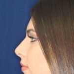 Closed Rhinoplasty - Left Profile - After Pic - Hump removal - Tip refinement - Sculpture of nose tip angle - Nose Job in Beverly Hills
