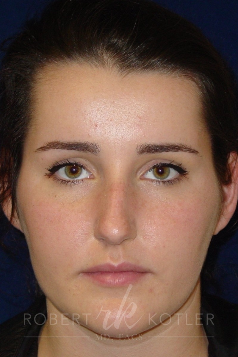 Closed Rhinoplasty - Front face view - Before Pic - Hump removal - Tip refinement - Nose tip elevated from lip - Best Rhinoplasty Beverly Hills