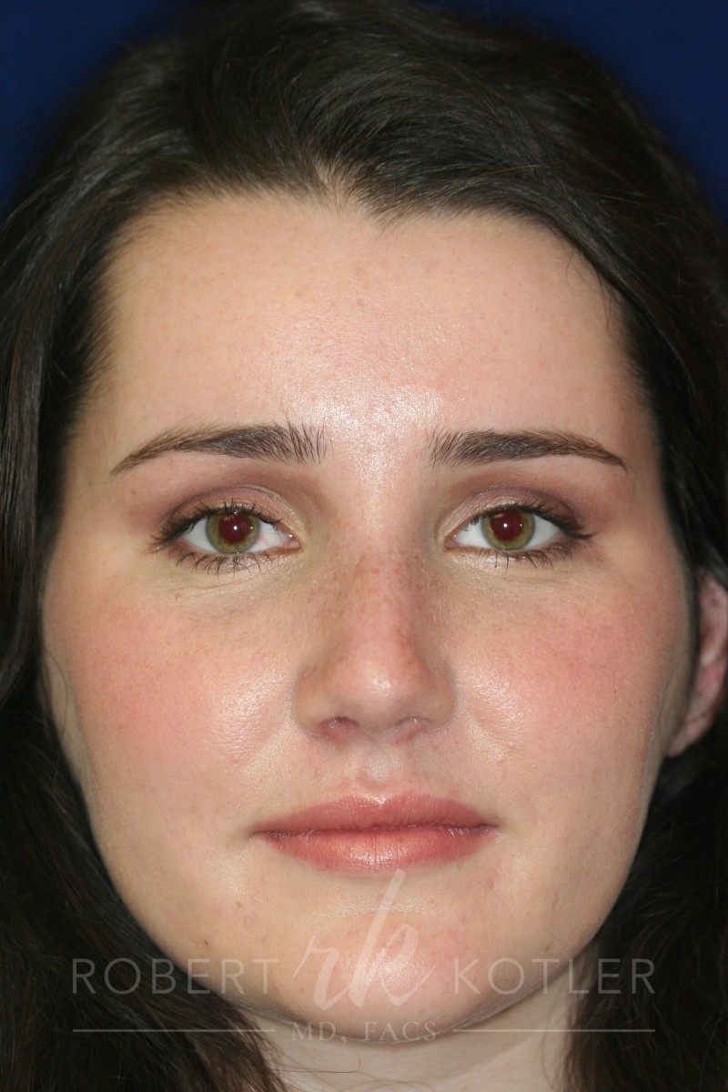 Closed Rhinoplasty - Front face view - After Pic - Hump removal - Tip refinement - Nose tip elevated from lip - Rhinoplasty Surgeon in Beverly Hills
