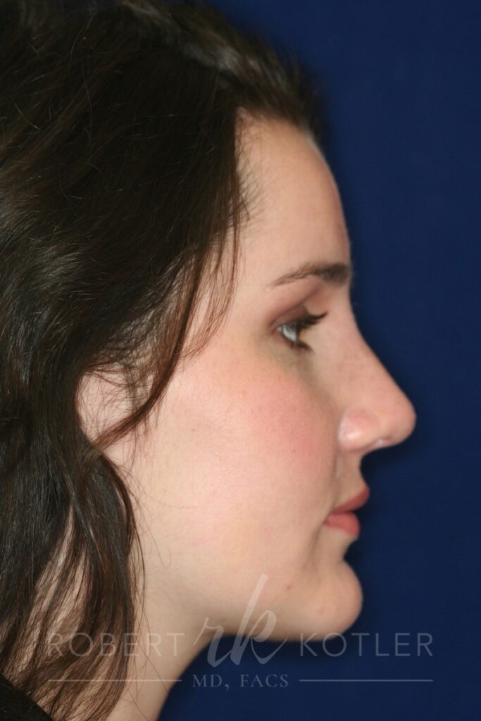 Closed Rhinoplasty - Right Profile - After Pic - Hump removal - Tip refinement - Nose tip elevated from lip - Beverly Hills Rhinoplasty Superspecialist
