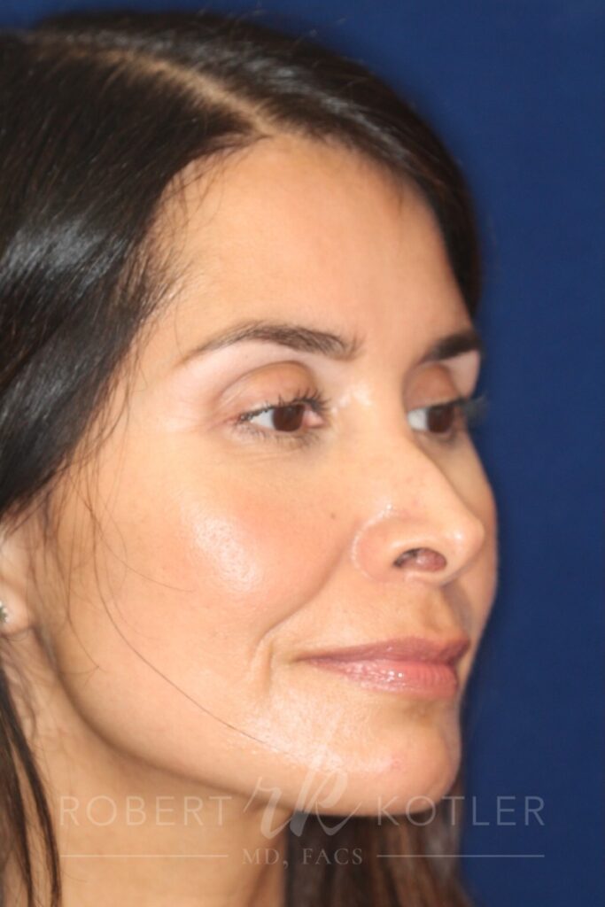 Closed Rhinoplasty - Right Profile - Before Pic - Columella elevation - Hump removal - Nose tip refinement - Nose Job in Beverly Hills