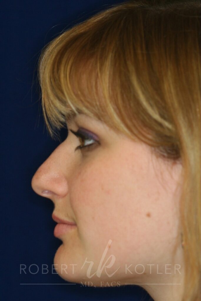 Closed Rhinoplasty - Left Profile - Before Pic - Hump Removal - Nose tip refinement - Best Nose Job Surgeon
