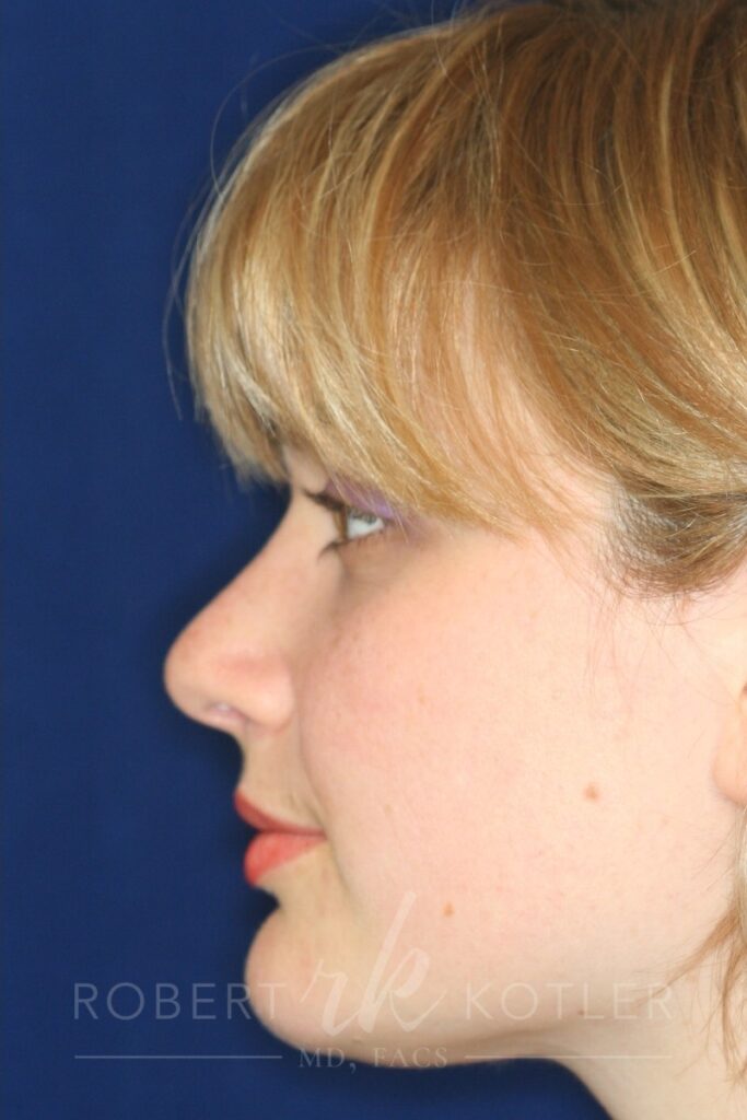 Closed Rhinoplasty - Left Profile - After Pic - Hump Removal - Nose tip refinement - Top Rhinoplasty Surgeon