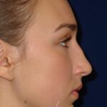 Closed Rhinoplasty - Right Profile - Before Pic - Nose tip refinement - Hump removal - Beverly Hills Rhinoplasty Superspecialist