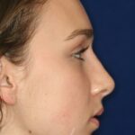 Closed Rhinoplasty - Right Profile - After Pic - Nose tip refinement - Hump removal - Best Rhinoplasty Beverly Hills