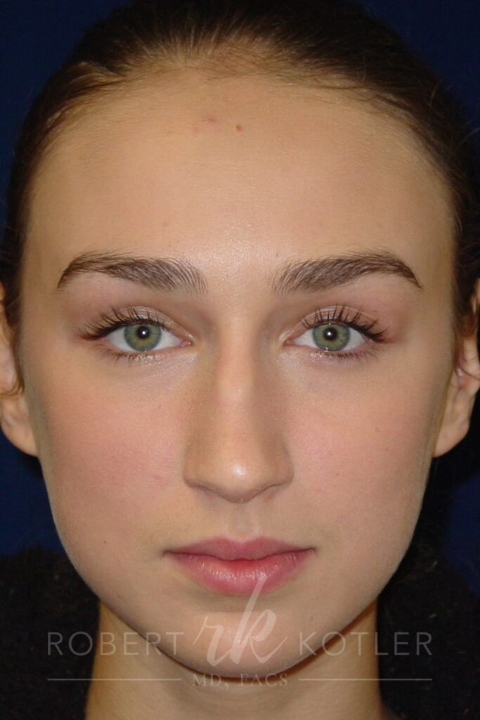 Closed Rhinoplasty - Front Face View - Before Pic - Nose tip refinement - Hump removal - Rhinoplasty Surgeon in Beverly Hills