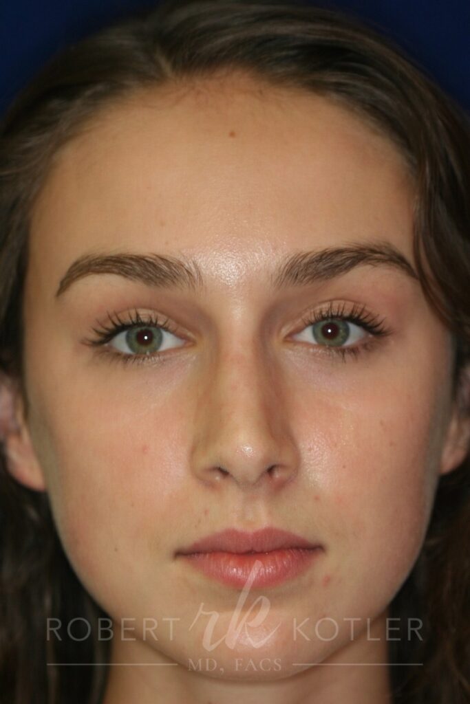 Closed Rhinoplasty - Front Face View - After Pic - Nose tip refinement - Hump removal - Nose Job in Beverly Hills