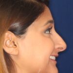 Closed Rhinoplasty -Right Profile - Before Pic - Removal of hump and nose tip refined - Beverly Hills Rhinoplasty Superspecialist